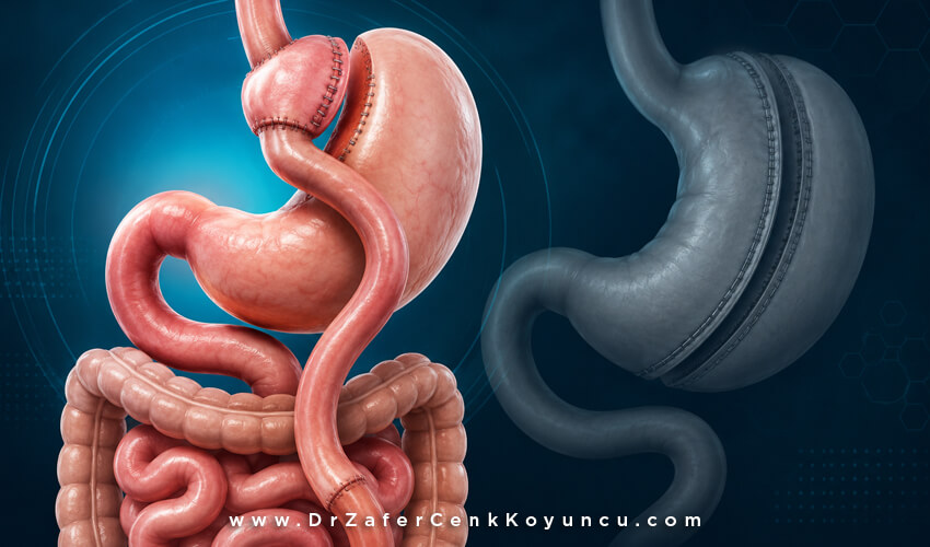 Gastric Sleeve or Gastric Bypass?